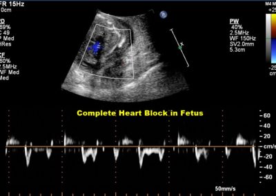 Complete Heart Block (CHB)
