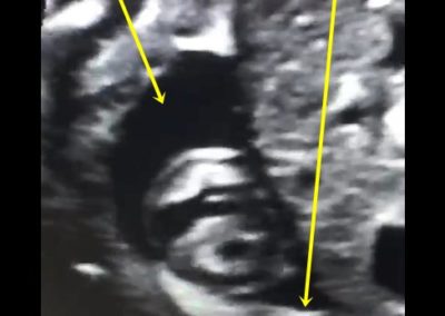 HYDROPS INTRAPERICARDIAL MASS