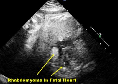 RHABDOMYOMA