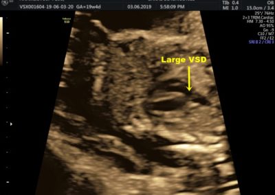 SUBPULMONEIC VSD