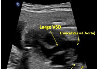 Truncus Arteriosus
