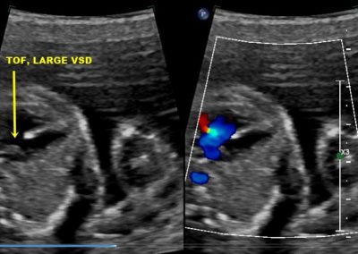Tetralogy of Fallot (TOF)