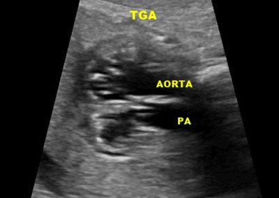 Transposition of Great Vessels (TGA)