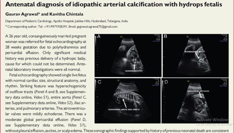 Antenatal diagnosis of idiopathic arterial calcification with hydrops fetalis